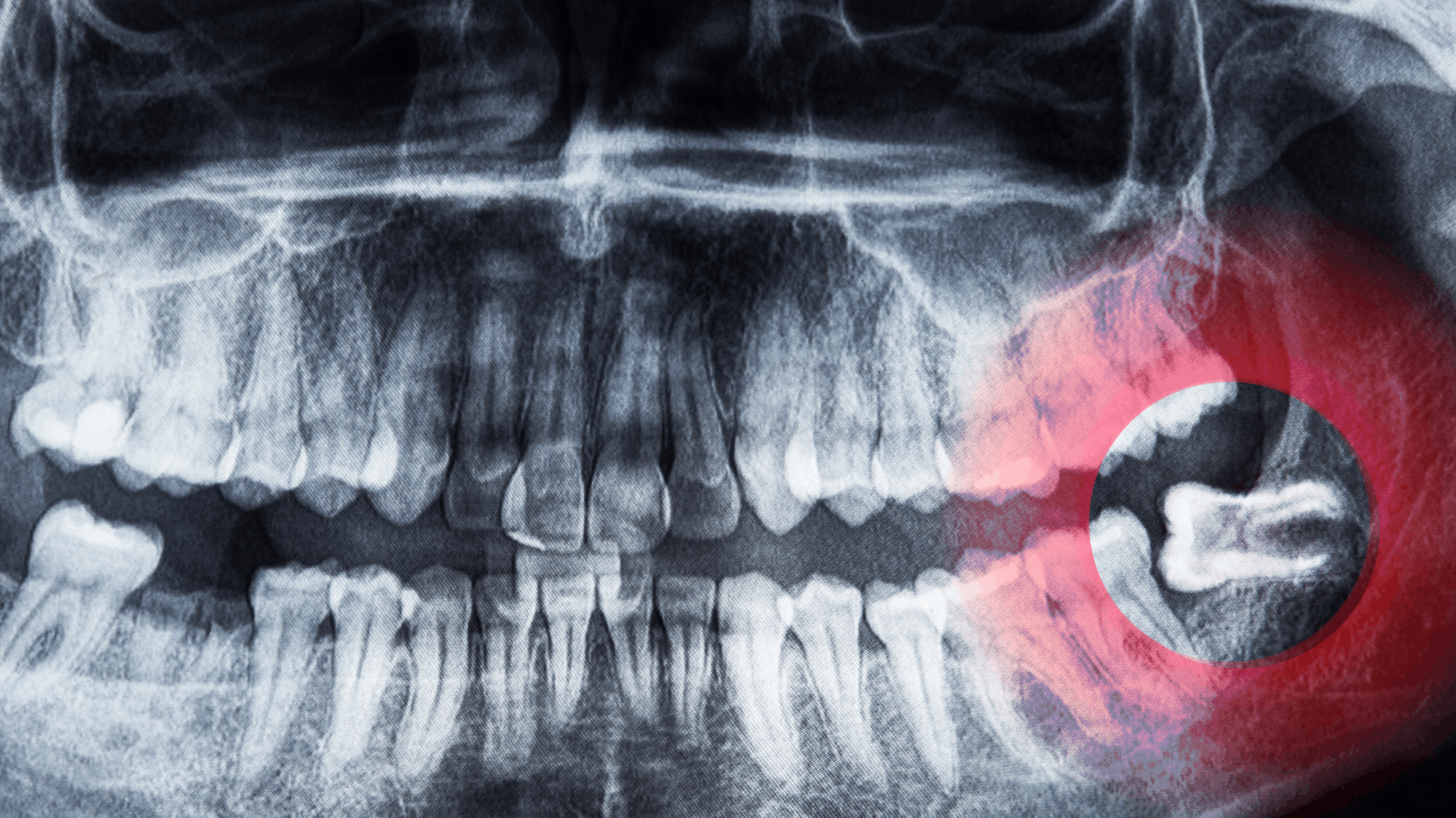 Understanding Wisdom Teeth Problems, Symptoms, and When Removal May Be Necessary